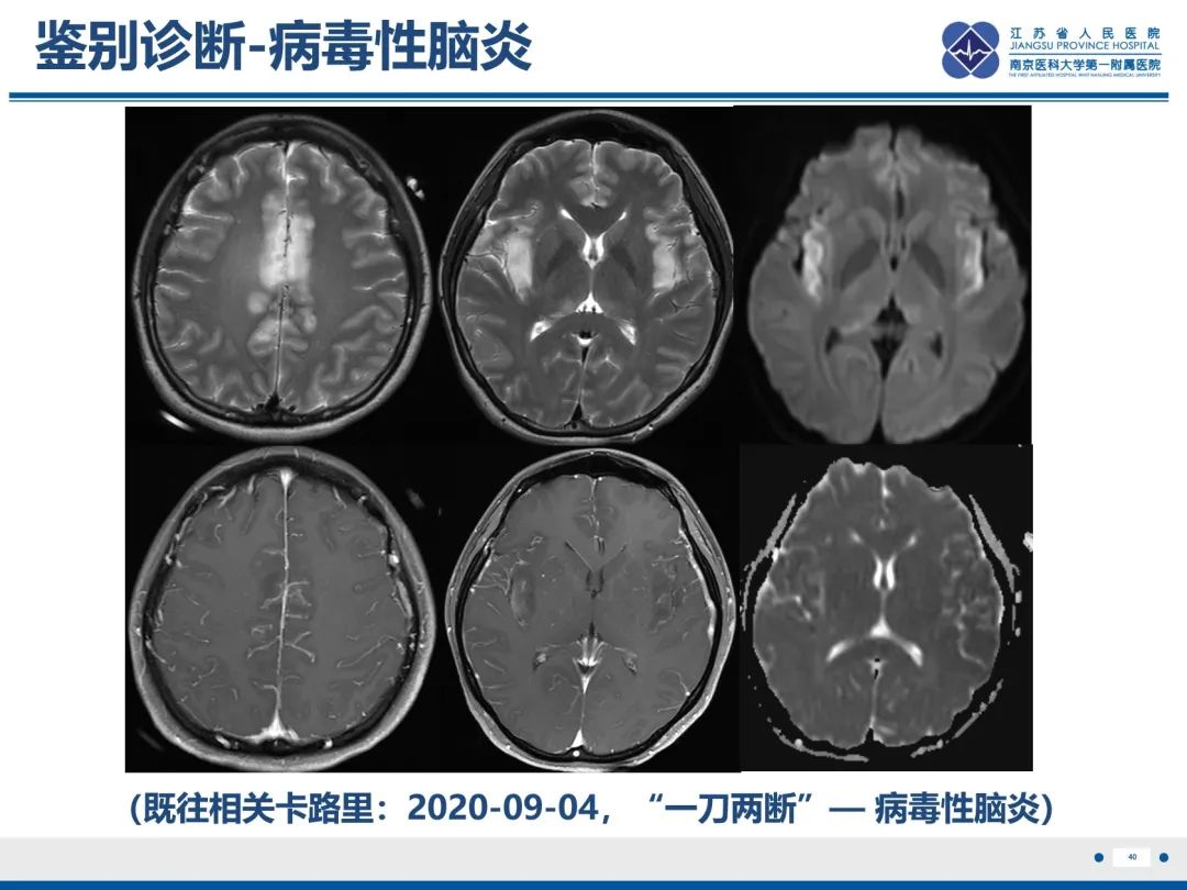 影像PPT - 【PPT】隐球菌脑膜脑炎-41