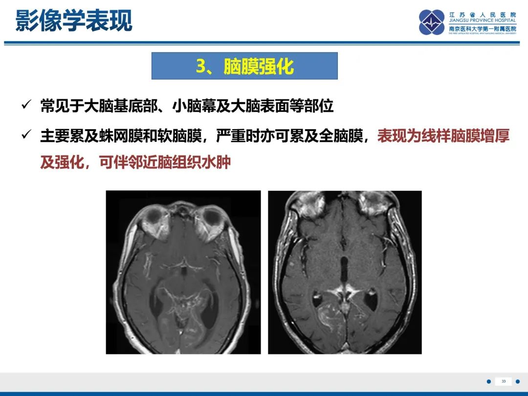 影像PPT - 【PPT】隐球菌脑膜脑炎-34