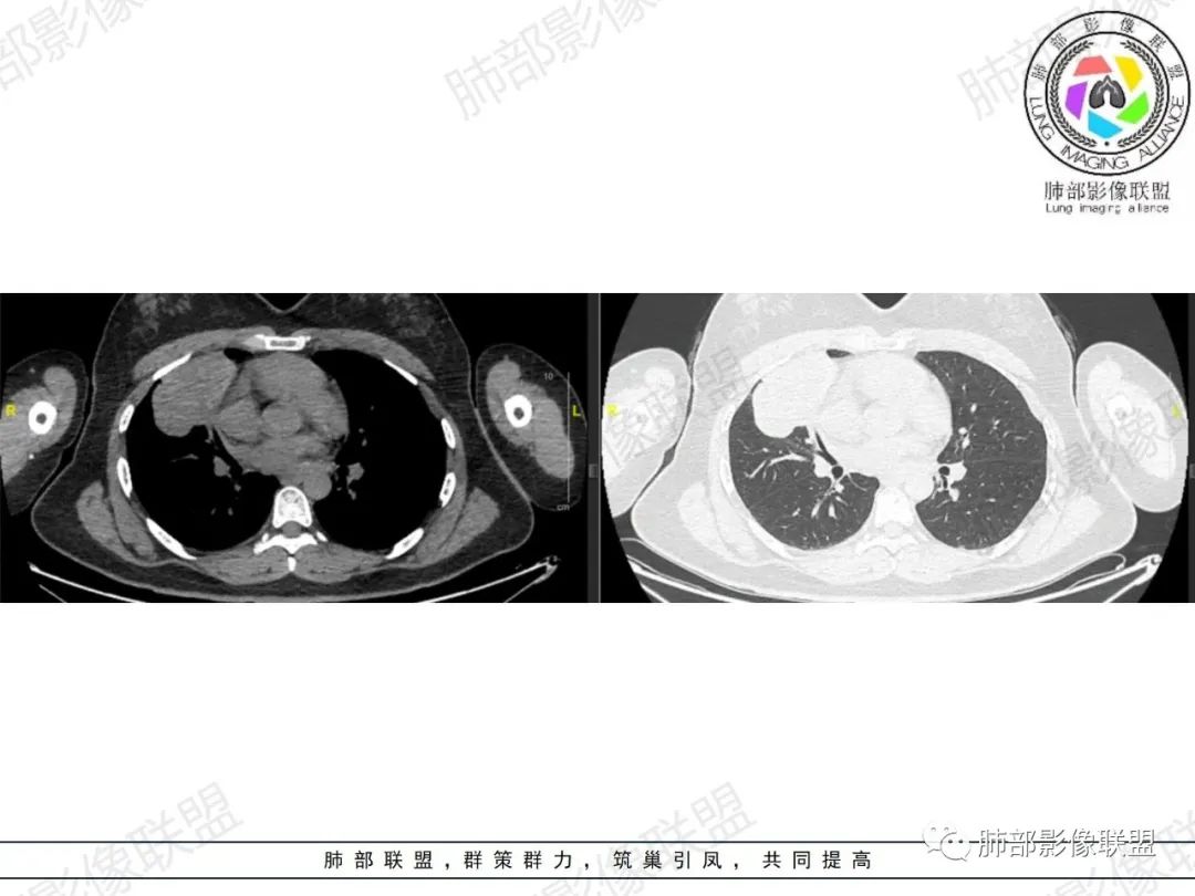 影像PPT - 【病例】罕见病理类型肺内肿瘤—绒毛膜癌1例-11 影像PPT - 【病例】罕见病理类型肺内肿瘤—绒毛膜癌1例-11