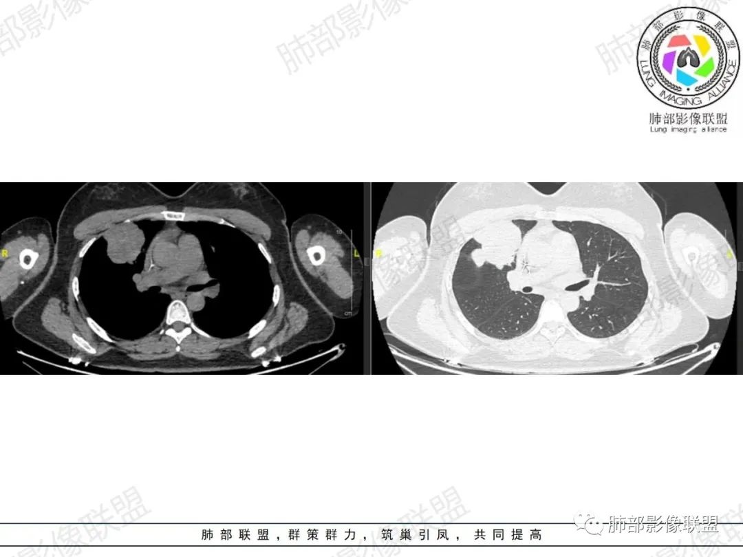 影像PPT - 【病例】罕见病理类型肺内肿瘤—绒毛膜癌1例-9 影像PPT - 【病例】罕见病理类型肺内肿瘤—绒毛膜癌1例-9