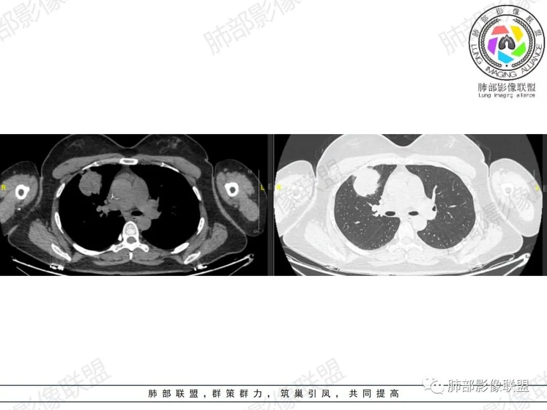 影像PPT - 【病例】罕见病理类型肺内肿瘤—绒毛膜癌1例-7 影像PPT - 【病例】罕见病理类型肺内肿瘤—绒毛膜癌1例-7