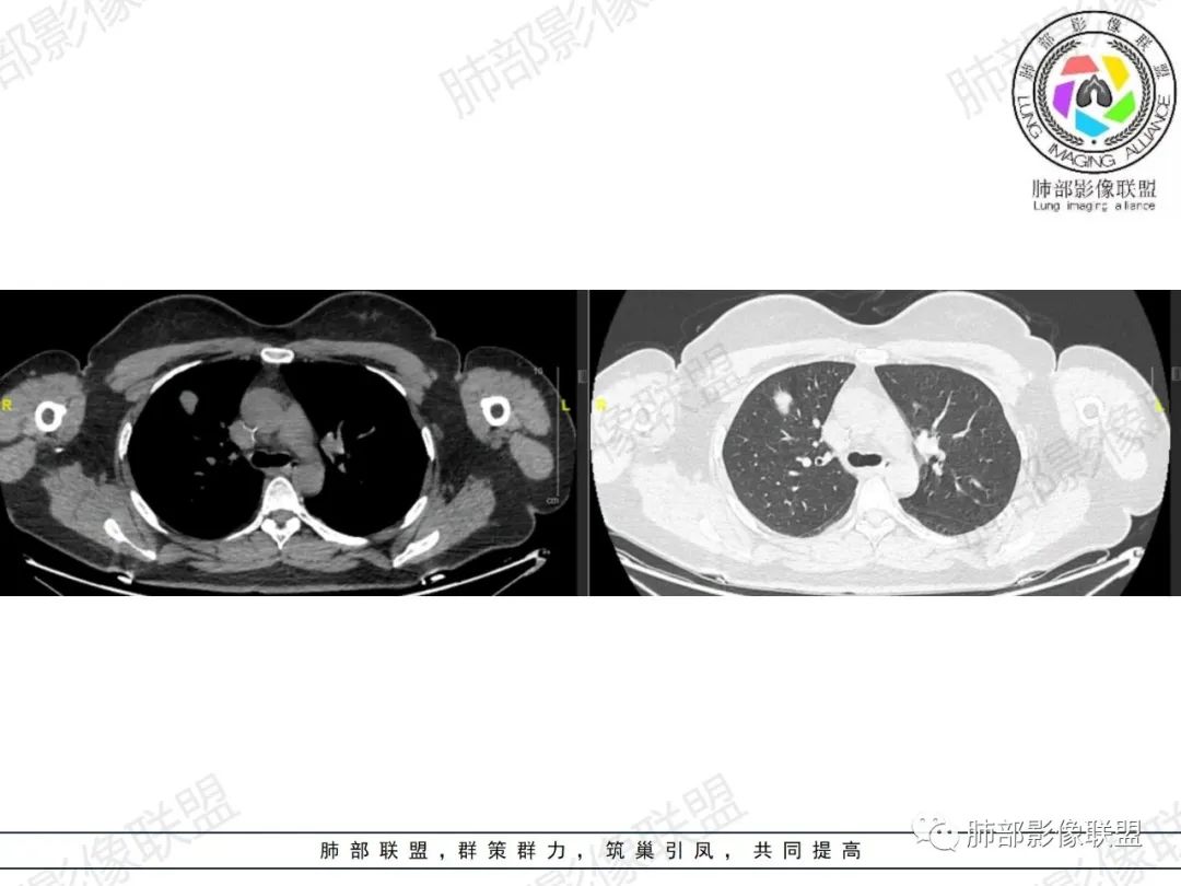 影像PPT - 【病例】罕见病理类型肺内肿瘤—绒毛膜癌1例-3 影像PPT - 【病例】罕见病理类型肺内肿瘤—绒毛膜癌1例-3
