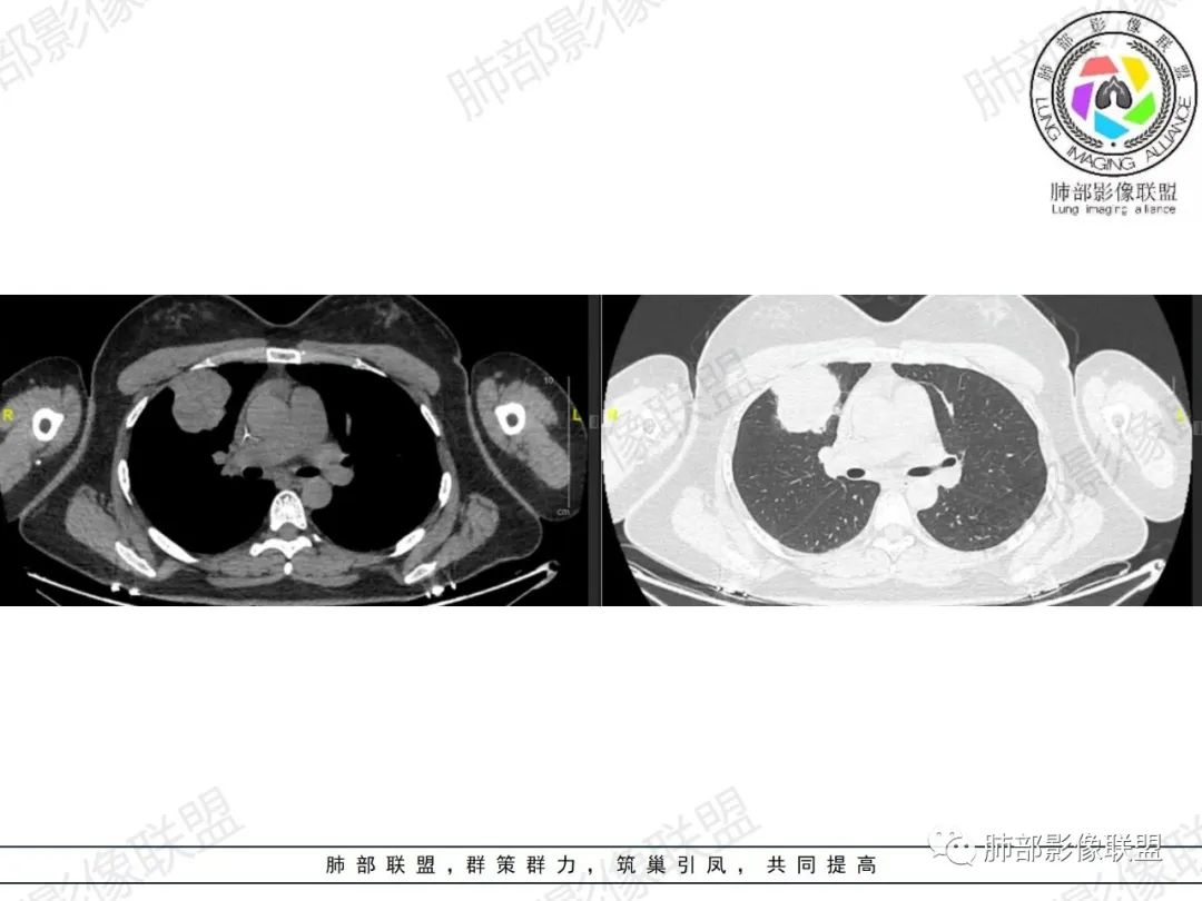 影像PPT - 【病例】罕见病理类型肺内肿瘤—绒毛膜癌1例-8 影像PPT - 【病例】罕见病理类型肺内肿瘤—绒毛膜癌1例-8