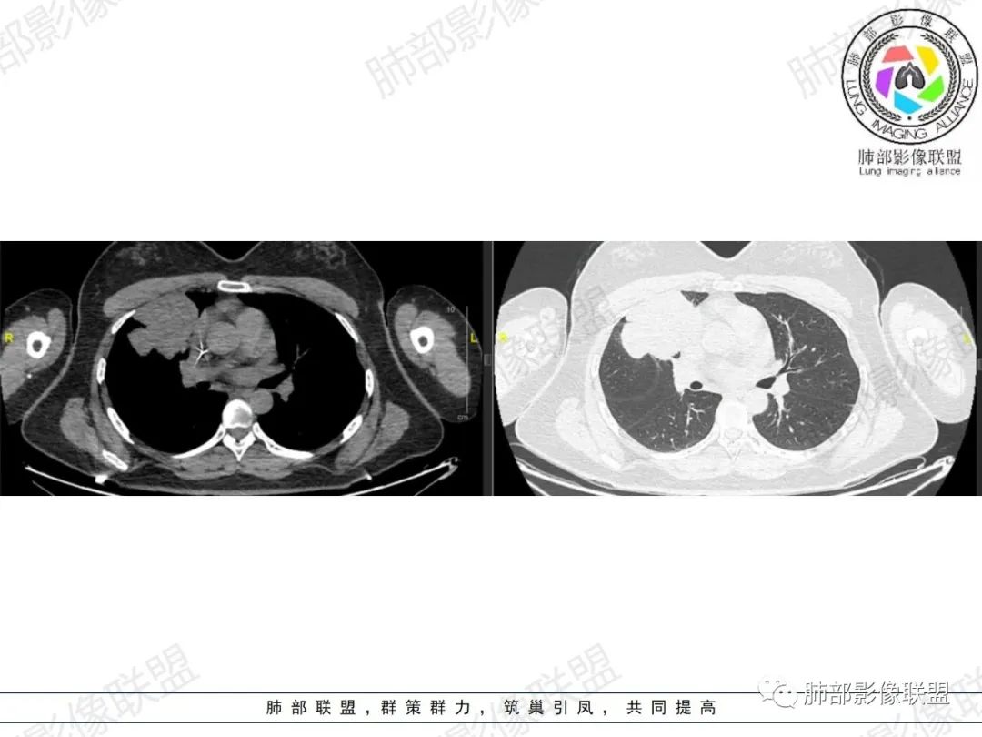 影像PPT - 【病例】罕见病理类型肺内肿瘤—绒毛膜癌1例-10 影像PPT - 【病例】罕见病理类型肺内肿瘤—绒毛膜癌1例-10