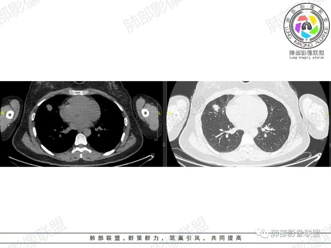 影像PPT - 【病例】罕见病理类型肺内肿瘤—绒毛膜癌1例-15 影像PPT - 【病例】罕见病理类型肺内肿瘤—绒毛膜癌1例-15