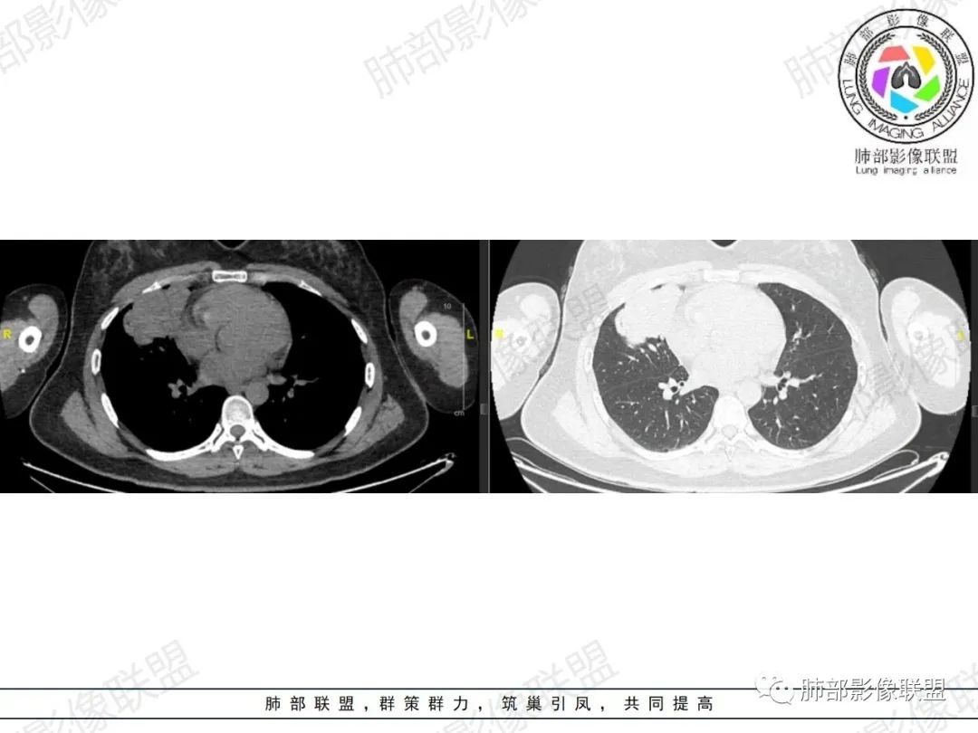 影像PPT - 【病例】罕见病理类型肺内肿瘤—绒毛膜癌1例-13 影像PPT - 【病例】罕见病理类型肺内肿瘤—绒毛膜癌1例-13