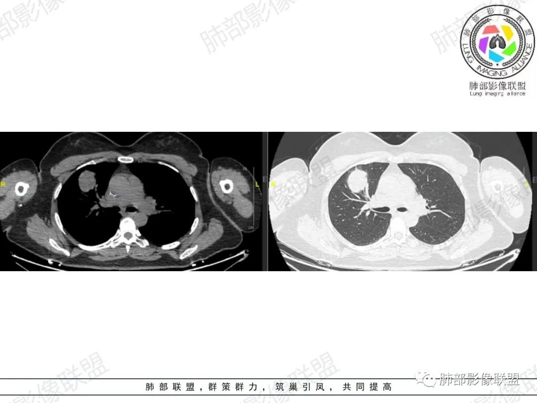 影像PPT - 【病例】罕见病理类型肺内肿瘤—绒毛膜癌1例-5 影像PPT - 【病例】罕见病理类型肺内肿瘤—绒毛膜癌1例-5