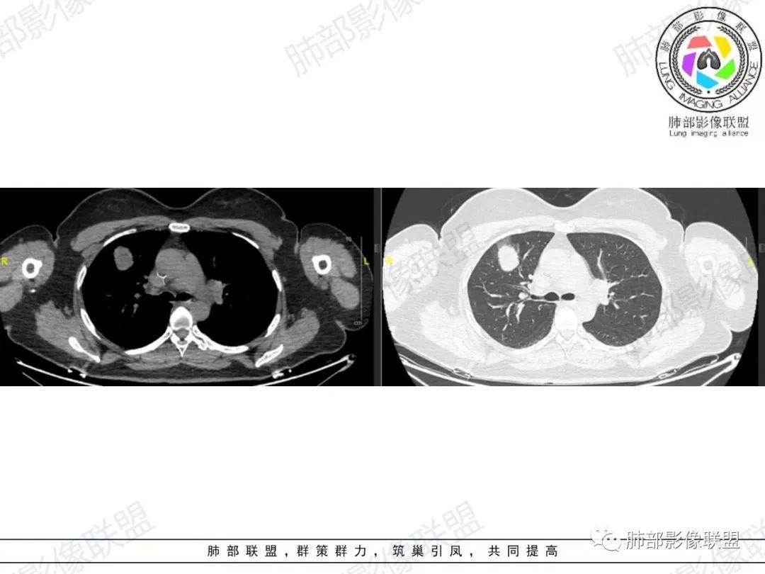 影像PPT - 【病例】罕见病理类型肺内肿瘤—绒毛膜癌1例-4 影像PPT - 【病例】罕见病理类型肺内肿瘤—绒毛膜癌1例-4