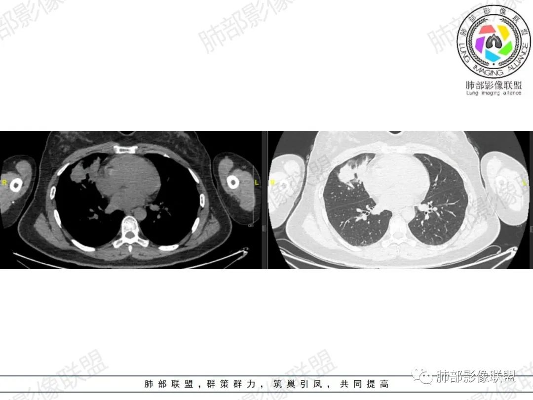 影像PPT - 【病例】罕见病理类型肺内肿瘤—绒毛膜癌1例-14 影像PPT - 【病例】罕见病理类型肺内肿瘤—绒毛膜癌1例-14