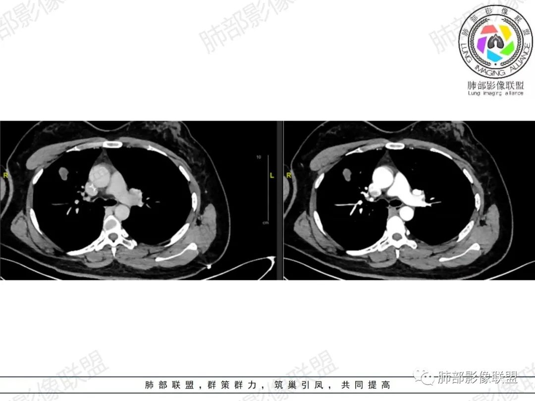 影像PPT - 【病例】罕见病理类型肺内肿瘤—绒毛膜癌1例-16 影像PPT - 【病例】罕见病理类型肺内肿瘤—绒毛膜癌1例-16