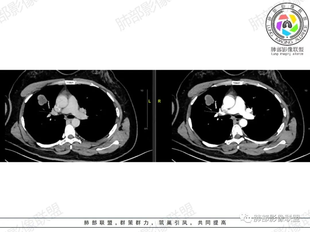 影像PPT - 【病例】罕见病理类型肺内肿瘤—绒毛膜癌1例-17 影像PPT - 【病例】罕见病理类型肺内肿瘤—绒毛膜癌1例-17