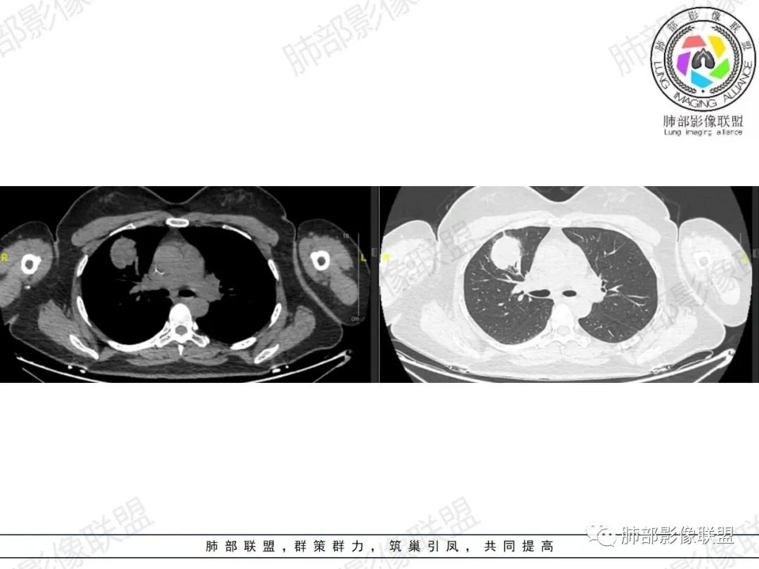 影像PPT - 【病例】罕见病理类型肺内肿瘤—绒毛膜癌1例-6 影像PPT - 【病例】罕见病理类型肺内肿瘤—绒毛膜癌1例-6