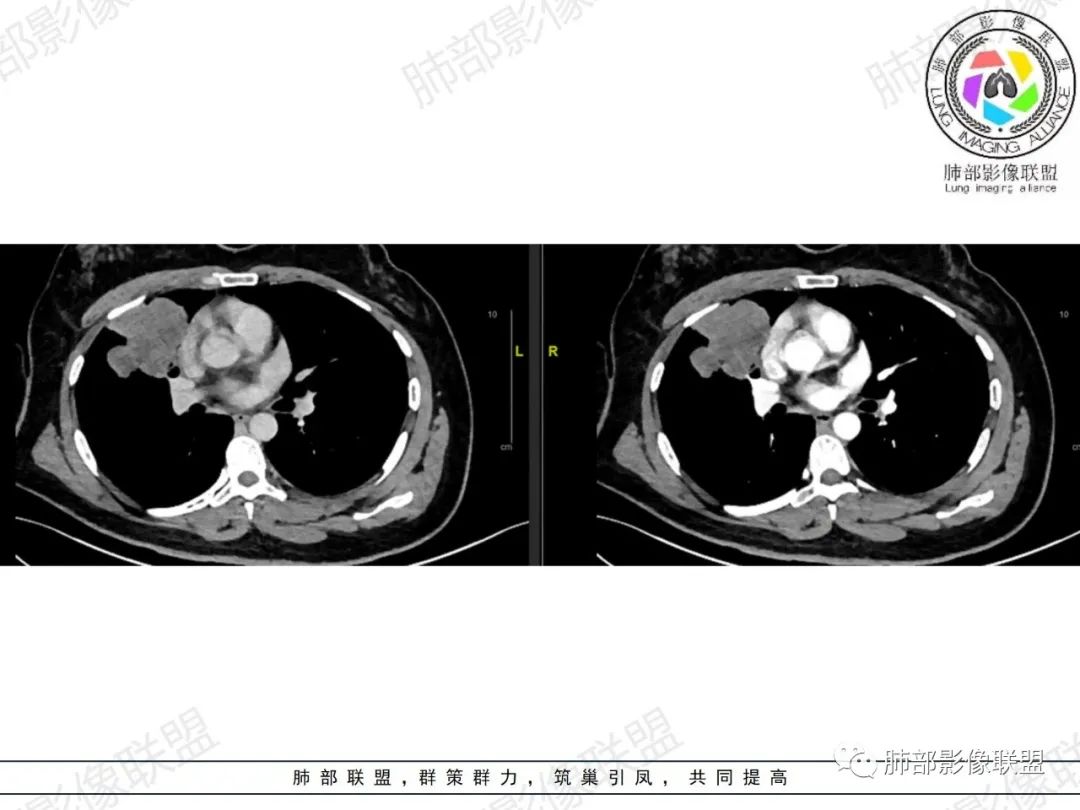 影像PPT - 【病例】罕见病理类型肺内肿瘤—绒毛膜癌1例-20 影像PPT - 【病例】罕见病理类型肺内肿瘤—绒毛膜癌1例-20