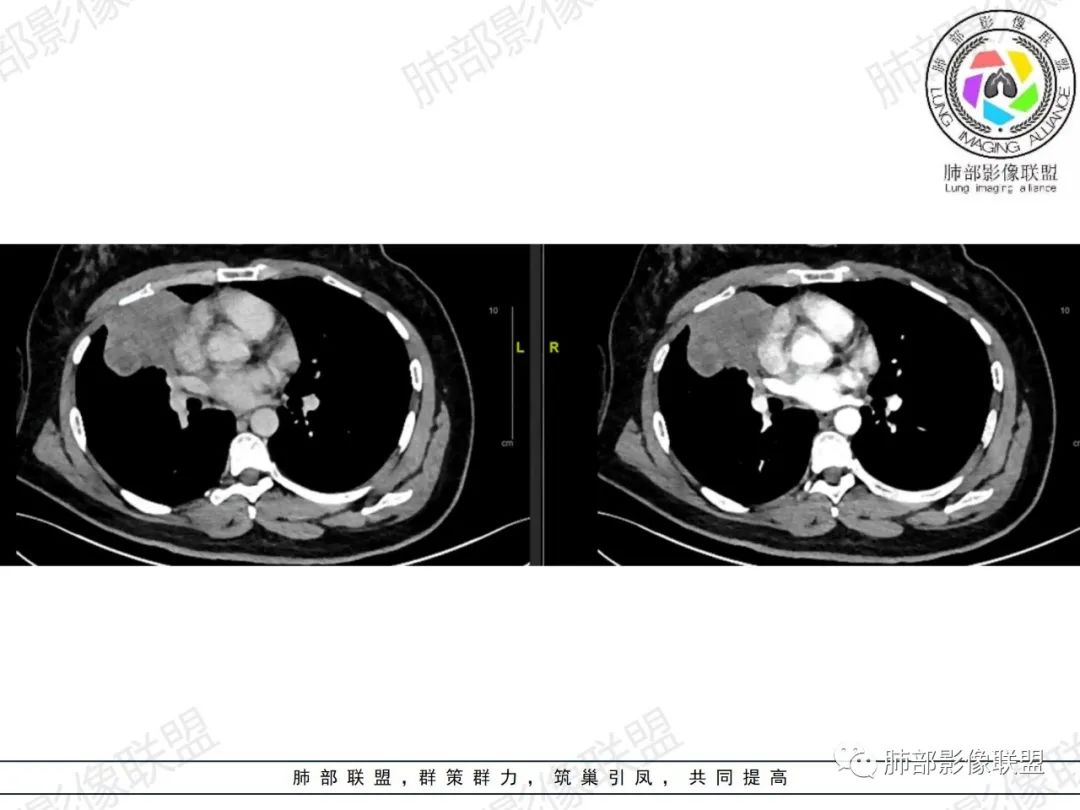 影像PPT - 【病例】罕见病理类型肺内肿瘤—绒毛膜癌1例-21 影像PPT - 【病例】罕见病理类型肺内肿瘤—绒毛膜癌1例-21