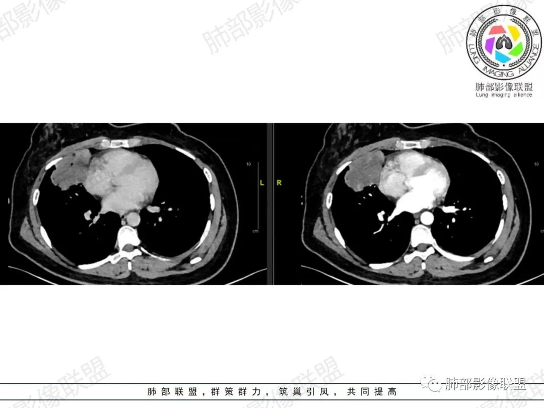 影像PPT - 【病例】罕见病理类型肺内肿瘤—绒毛膜癌1例-23 影像PPT - 【病例】罕见病理类型肺内肿瘤—绒毛膜癌1例-23