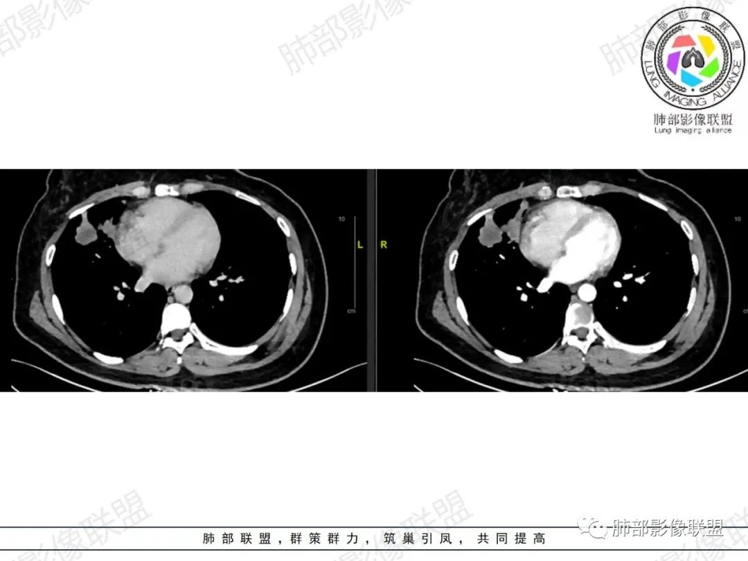 影像PPT - 【病例】罕见病理类型肺内肿瘤—绒毛膜癌1例-24 影像PPT - 【病例】罕见病理类型肺内肿瘤—绒毛膜癌1例-24