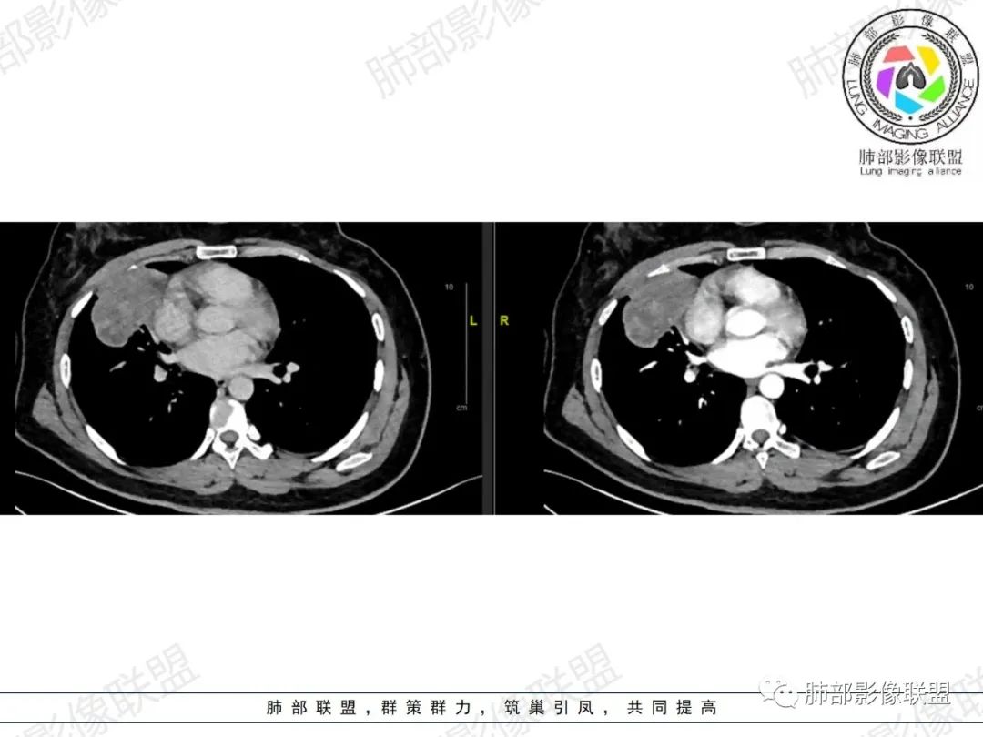影像PPT - 【病例】罕见病理类型肺内肿瘤—绒毛膜癌1例-22 影像PPT - 【病例】罕见病理类型肺内肿瘤—绒毛膜癌1例-22