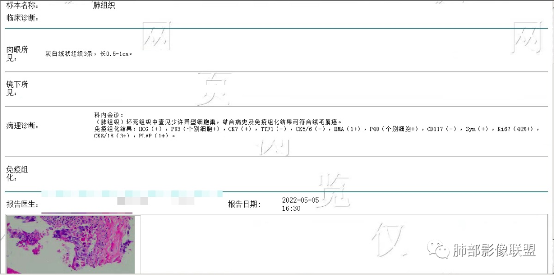 影像PPT - 【病例】罕见病理类型肺内肿瘤—绒毛膜癌1例-32 影像PPT - 【病例】罕见病理类型肺内肿瘤—绒毛膜癌1例-32