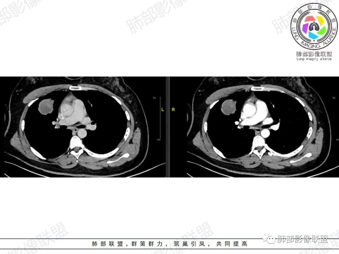 影像PPT - 【病例】罕见病理类型肺内肿瘤—绒毛膜癌1例-1 影像PPT - 【病例】罕见病理类型肺内肿瘤—绒毛膜癌1例-1