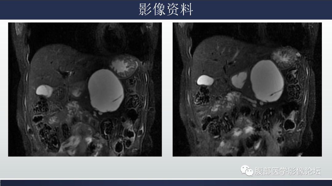 影像PPT - 【病例】胰腺粘液性囊腺瘤1例-4
