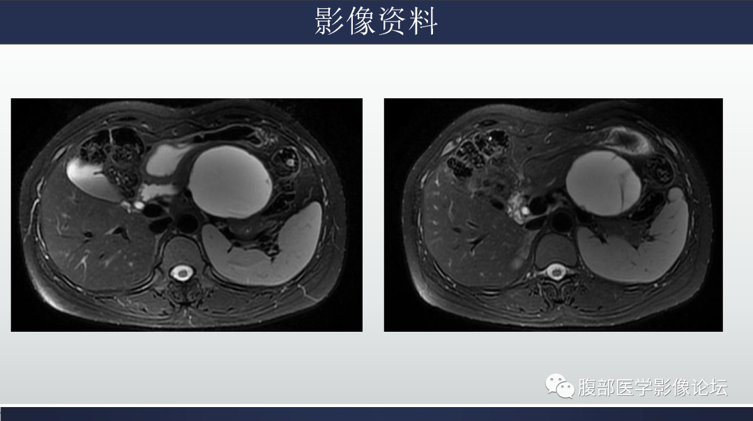 影像PPT - 【病例】胰腺粘液性囊腺瘤1例-5