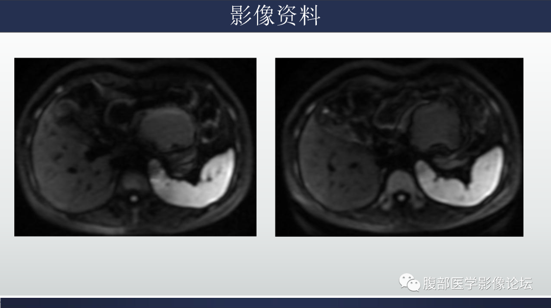 影像PPT - 【病例】胰腺粘液性囊腺瘤1例-7