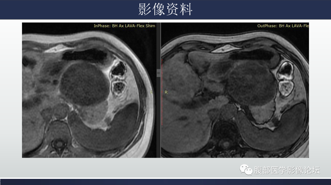 影像PPT - 【病例】胰腺粘液性囊腺瘤1例-8