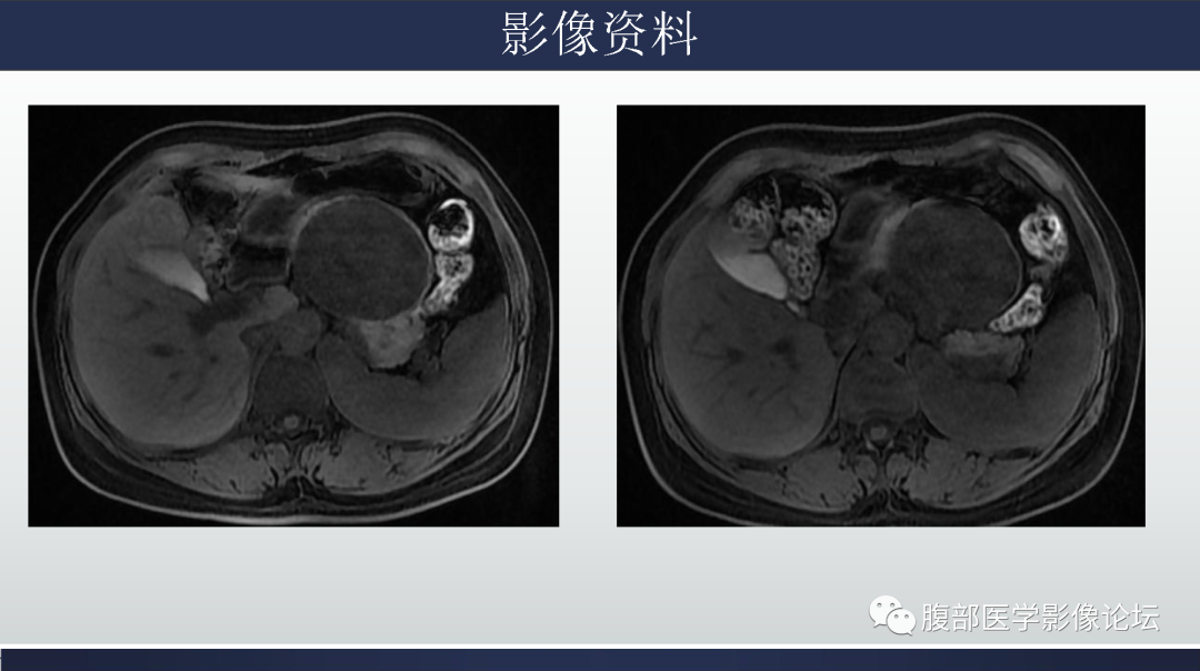 影像PPT - 【病例】胰腺粘液性囊腺瘤1例-6