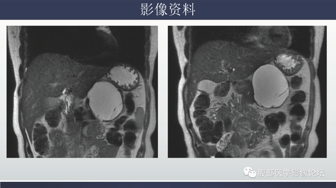 影像PPT - 【病例】胰腺粘液性囊腺瘤1例-3