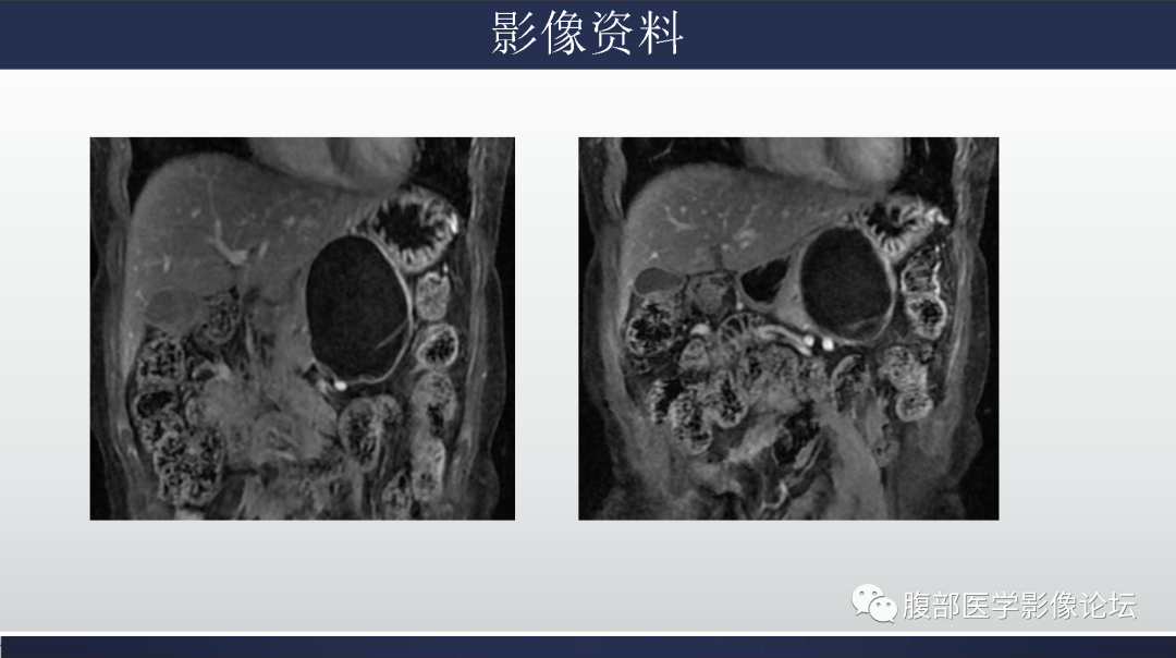 影像PPT - 【病例】胰腺粘液性囊腺瘤1例-10