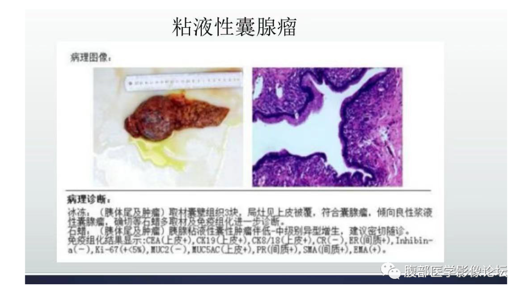 影像PPT - 【病例】胰腺粘液性囊腺瘤1例-11