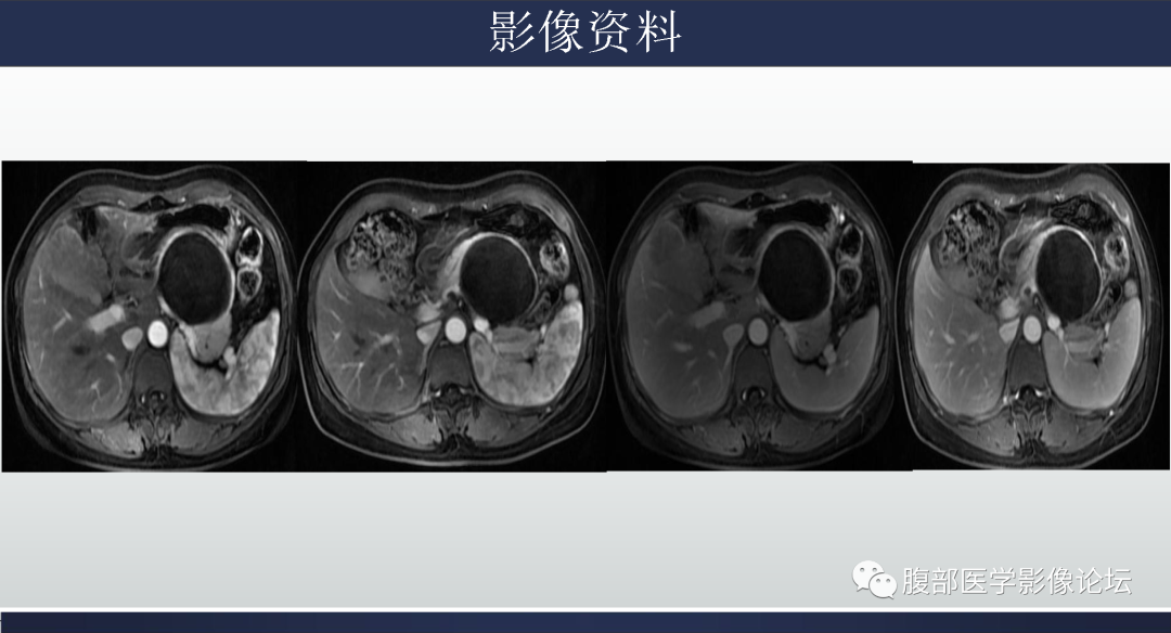 影像PPT - 【病例】胰腺粘液性囊腺瘤1例-9