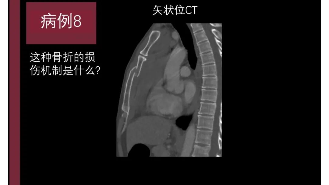影像PPT - 【PPT】胸骨与胸锁关节-1