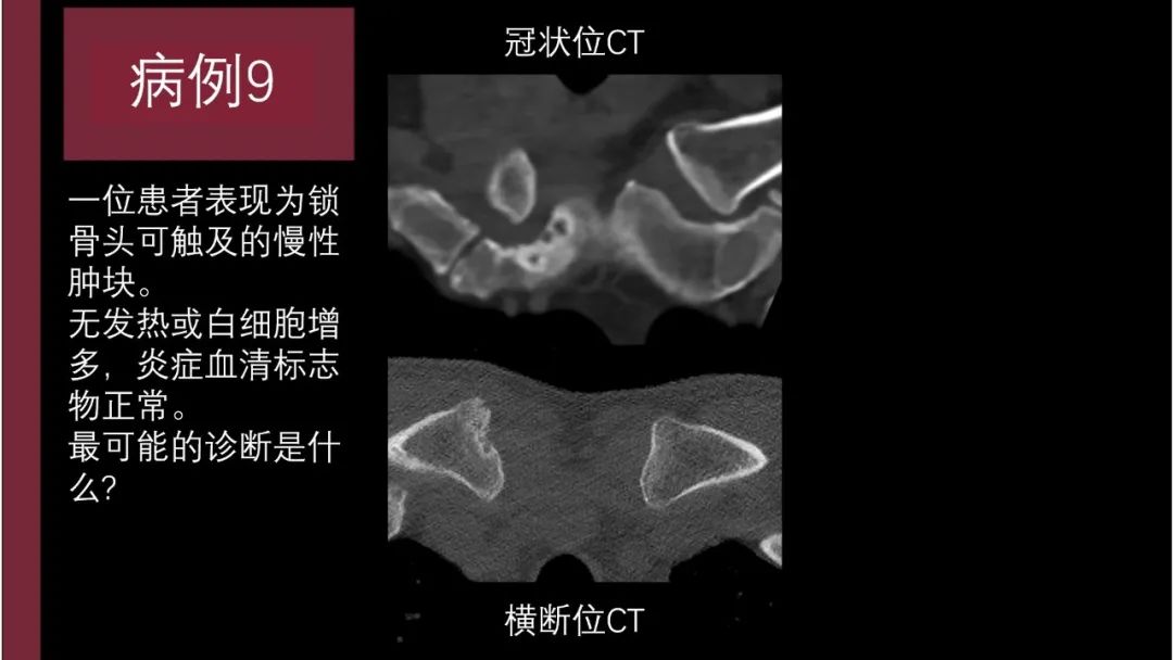 影像PPT - 【PPT】胸骨与胸锁关节-5