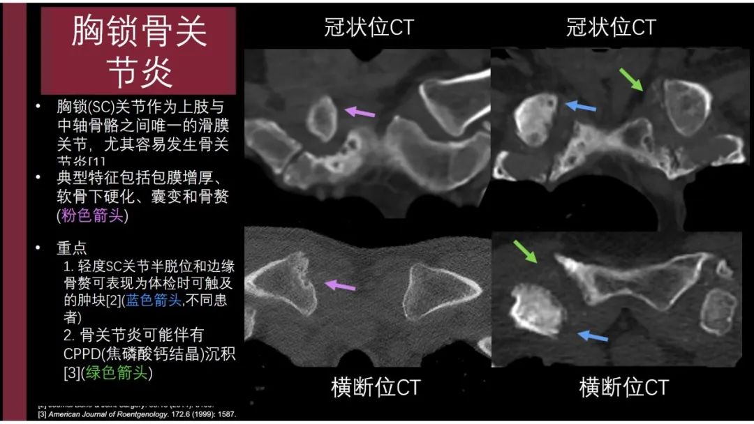 影像PPT - 【PPT】胸骨与胸锁关节-7