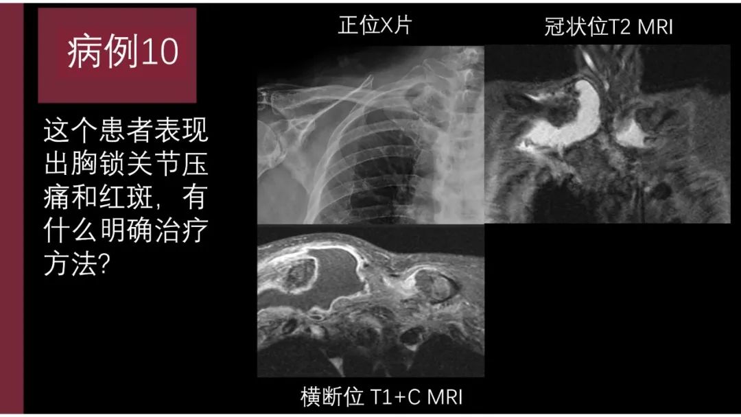 影像PPT - 【PPT】胸骨与胸锁关节-9