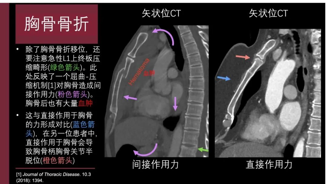 影像PPT - 【PPT】胸骨与胸锁关节-3