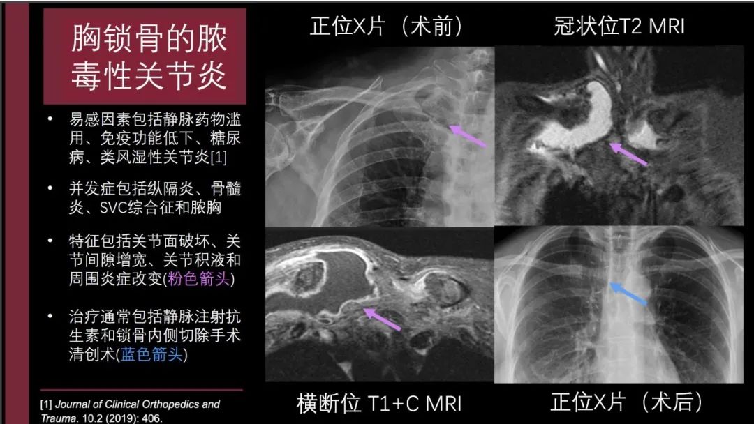 影像PPT - 【PPT】胸骨与胸锁关节-11