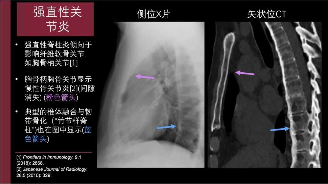 影像PPT - 【PPT】胸骨与胸锁关节-15