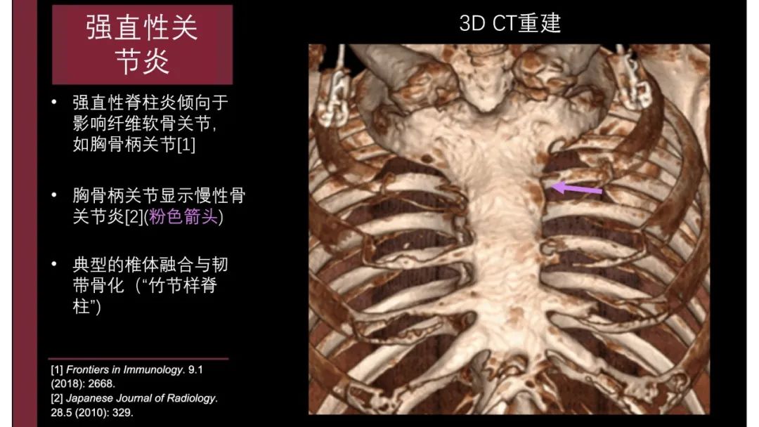 影像PPT - 【PPT】胸骨与胸锁关节-17