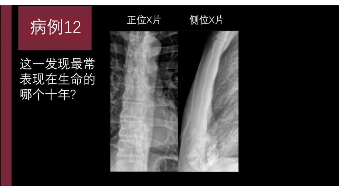 影像PPT - 【PPT】胸骨与胸锁关节-19