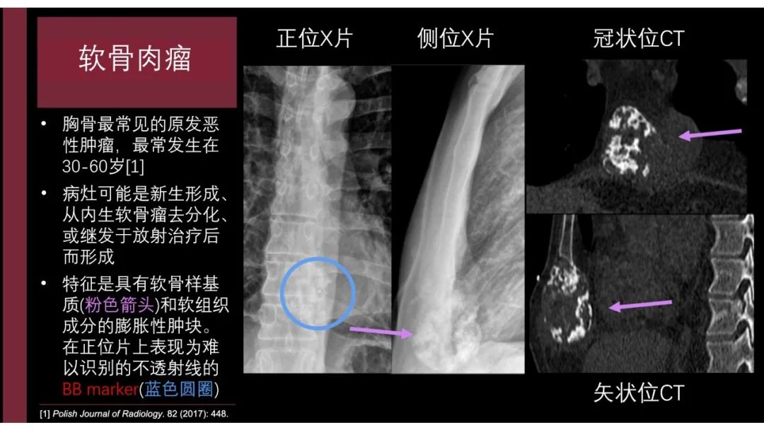影像PPT - 【PPT】胸骨与胸锁关节-21