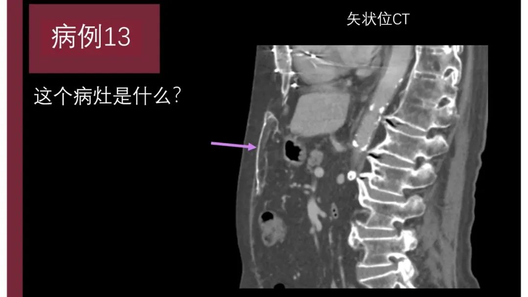 影像PPT - 【PPT】胸骨与胸锁关节-25