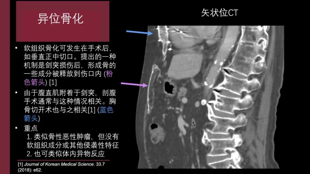 影像PPT - 【PPT】胸骨与胸锁关节-27