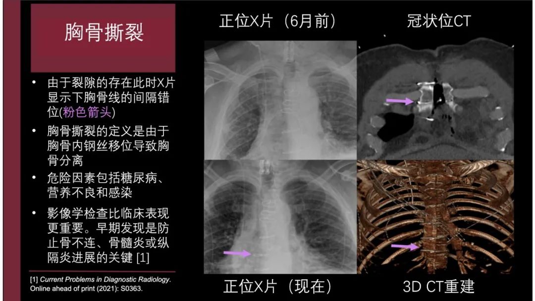 影像PPT - 【PPT】胸骨与胸锁关节-31