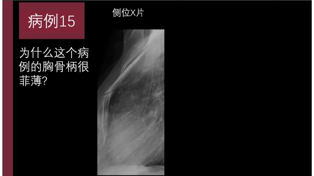 影像PPT - 【PPT】胸骨与胸锁关节-33