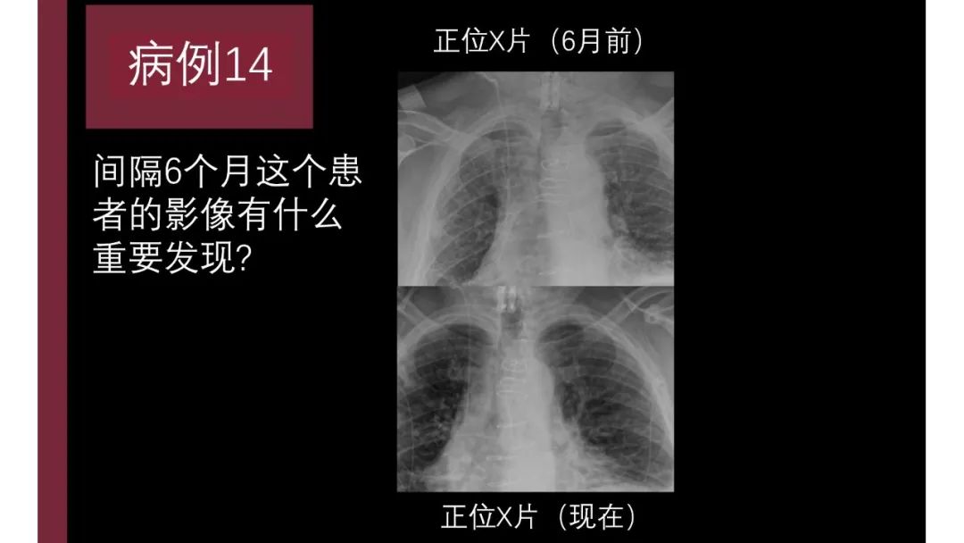 影像PPT - 【PPT】胸骨与胸锁关节-29