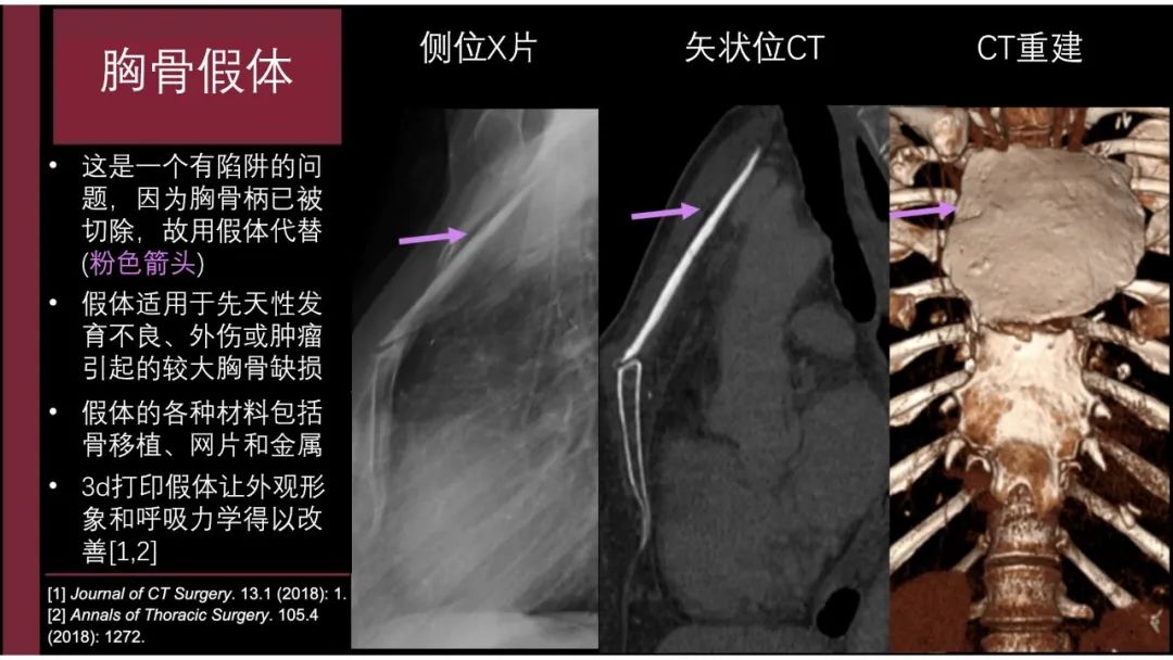 影像PPT - 【PPT】胸骨与胸锁关节-35