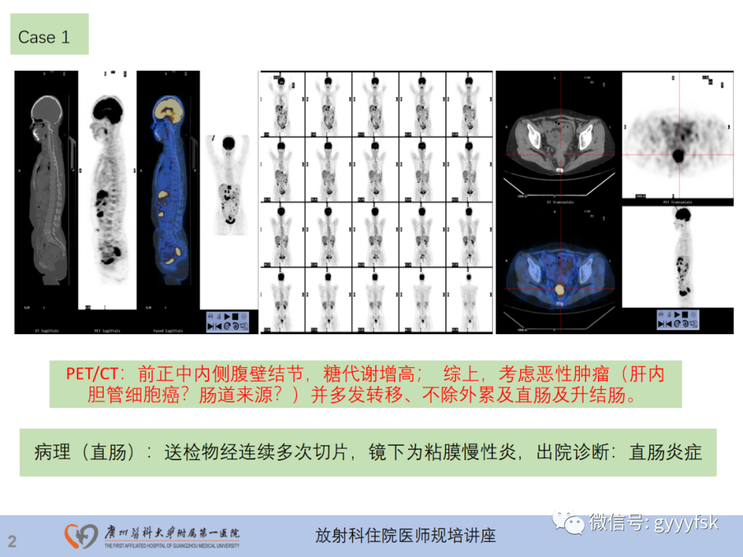 影像PPT - 【PPT】直肠癌MRI规范扫描及分期诊断-3