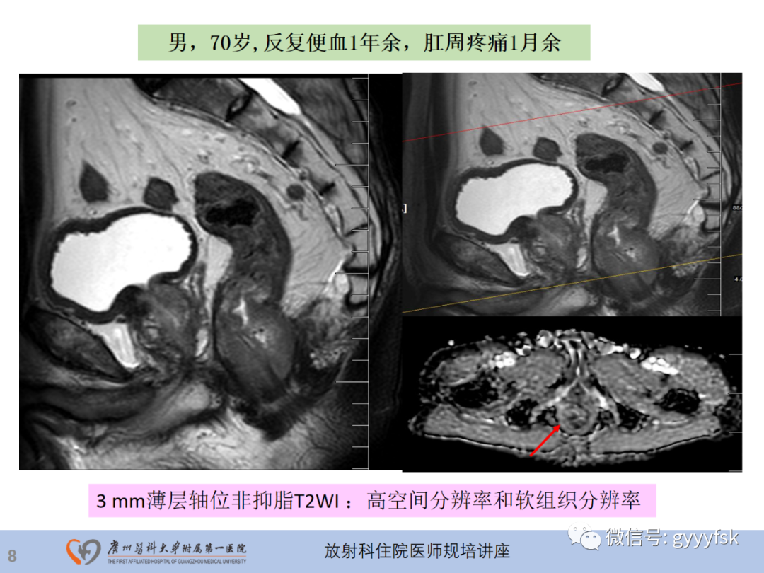 影像PPT - 【PPT】直肠癌MRI规范扫描及分期诊断-9